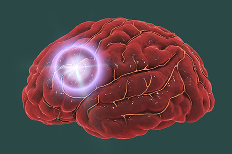 Vagus Nerve Stimulation Possible Boost to Post  Stroke  